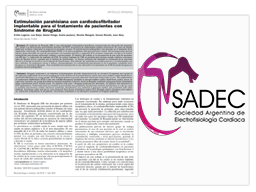 Estimimulación parahisiana cardiodesfibrilador implantable tratamiento S. Brugada Vignette de l'article de Sadec