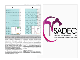 Que aprendimos de sincronía biventricular con el uso de Syncromax Vignette de l'article de Sadec